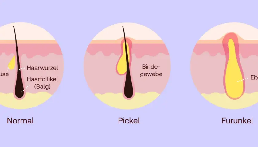 Illustration zeigt, was tun bei Furunkel: Normal, Pickel und Furunkel mit Eiterbildung im Haarfollikel.