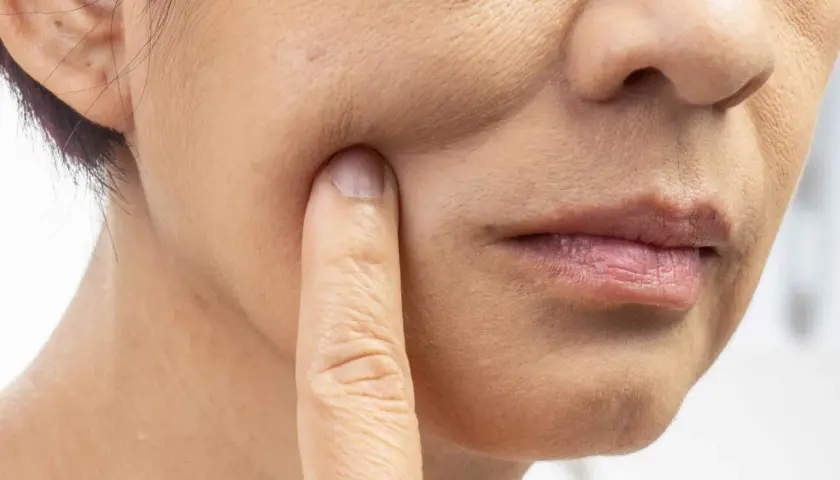 Nahaufnahme einer Frau, die mit dem Finger auf ihre Wange tippt. Die Haut zeigt Falten und Pigmentflecken, Anzeichen von **Hautalterung durch Sonne**.