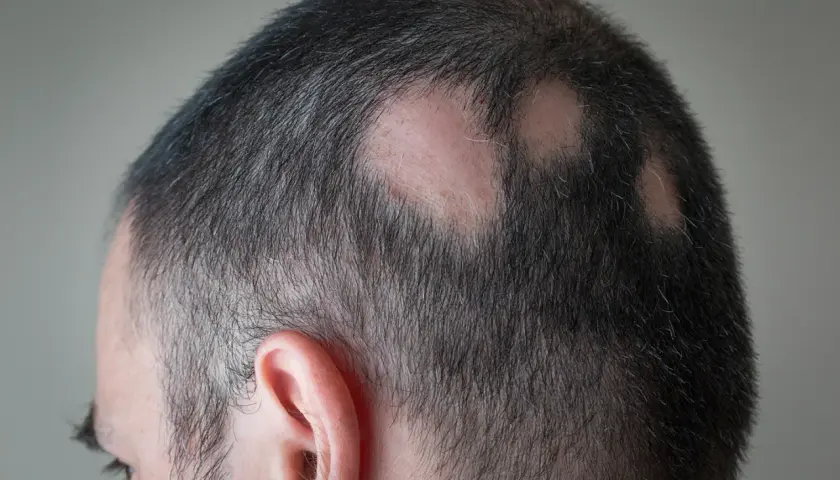 Mann mit kreisrundem Haarausfall am Hinterkopf. Vielleicht helfen Hausmittel gegen Kopfhautjucken.