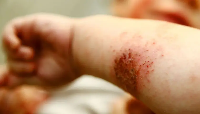 Babyarm mit geröteter, wund gekratzter Stelle, die stark juckt. Neurodermitis-Schub.