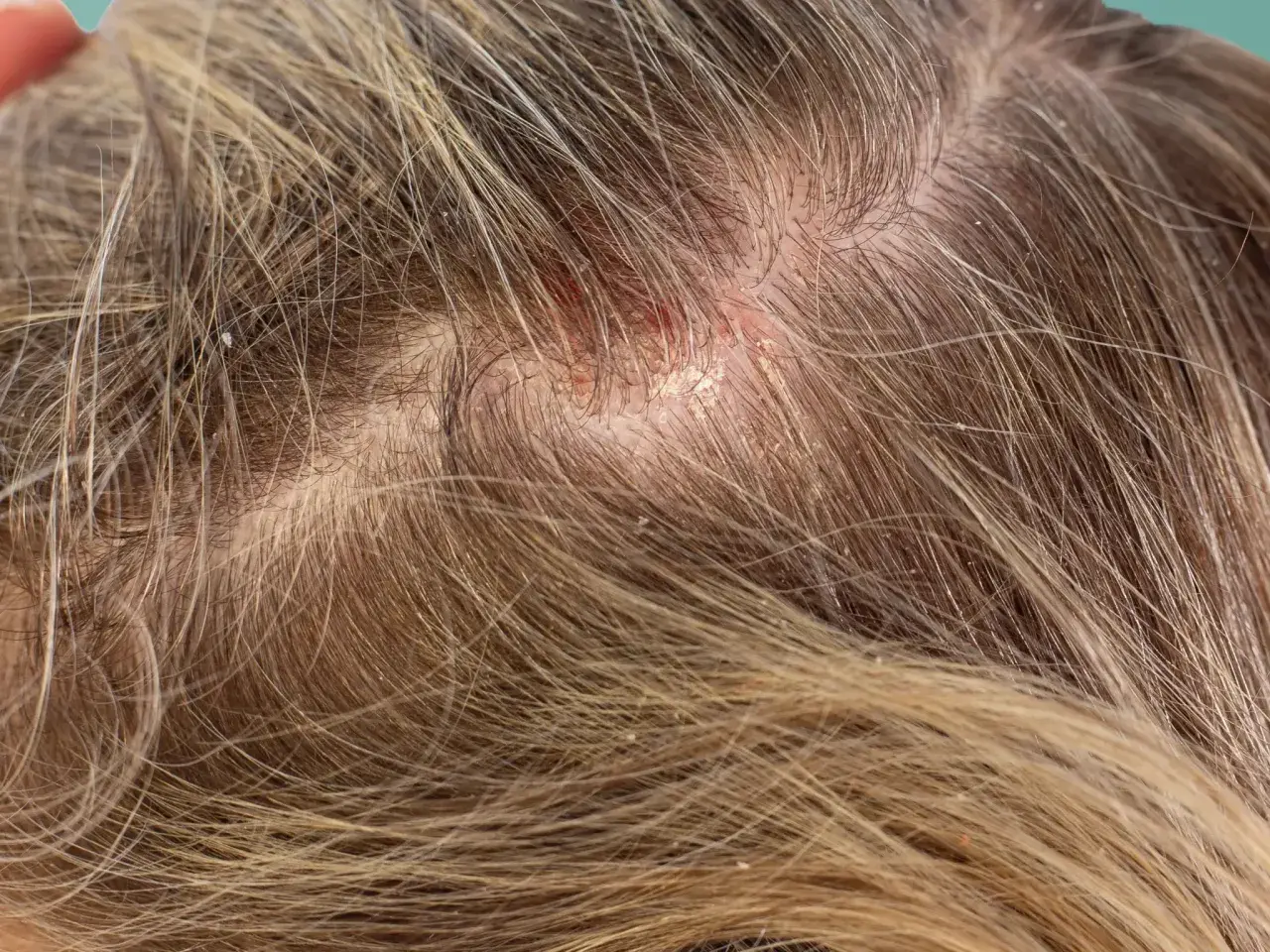 Nahaufnahme einer Kopfhaut mit sichtbaren Schuppen und Rötungen. Die Haare sind hellbraun und durchzogen von feinen Schuppen.