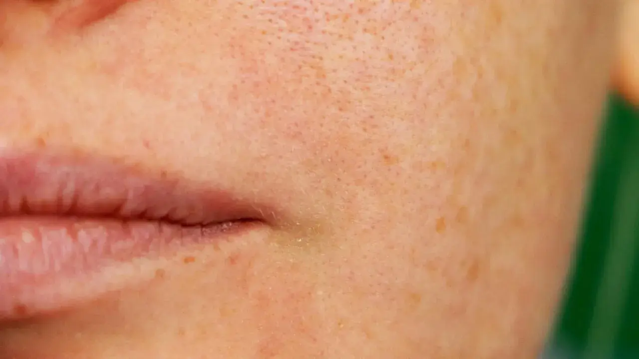 Nahaufnahme der Haut mit sichtbaren, erweiterten Poren und Sommersprossen neben den Lippen.