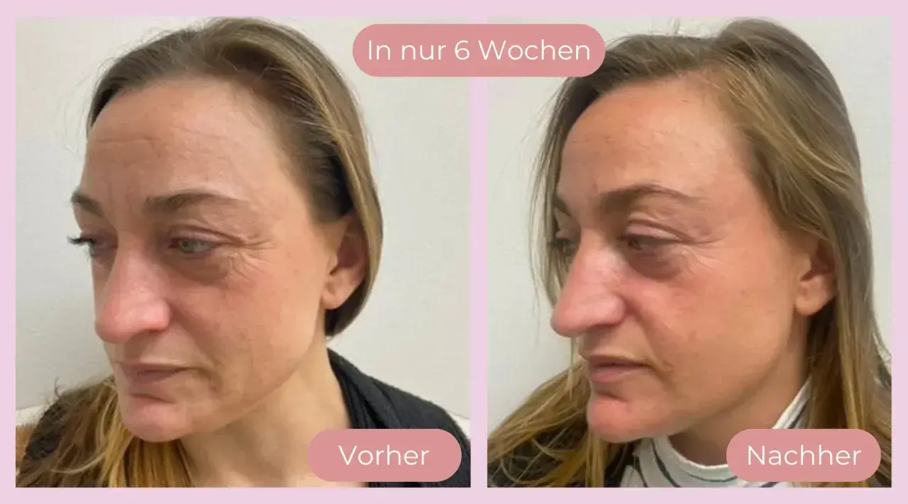 Vorher-nachher Vergleich der Haut nach 6 Wochen Anwendung von Vitamin C. Deutliche Reduzierung von Falten und Verbesserung des Hautbildes.