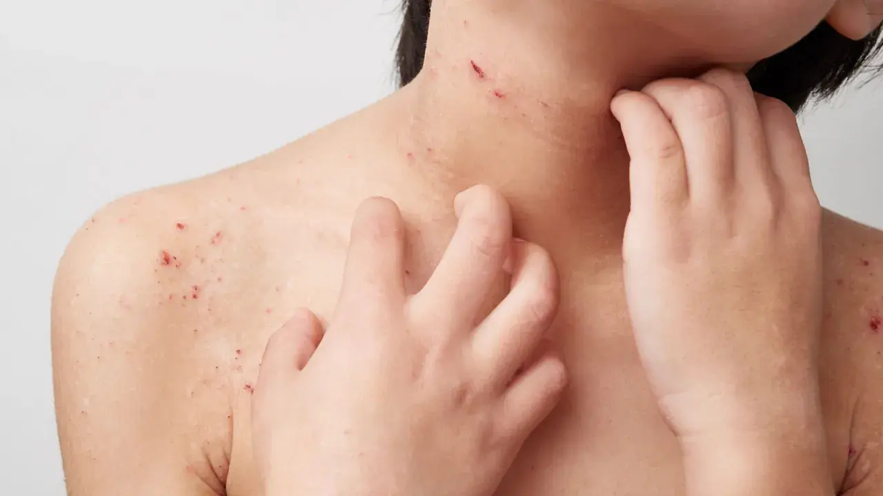 Haut mit roten Flecken und Kratzern, die auf Neurodermitis Pusteln hindeuten. Eine Hand kratzt sich am Hals.