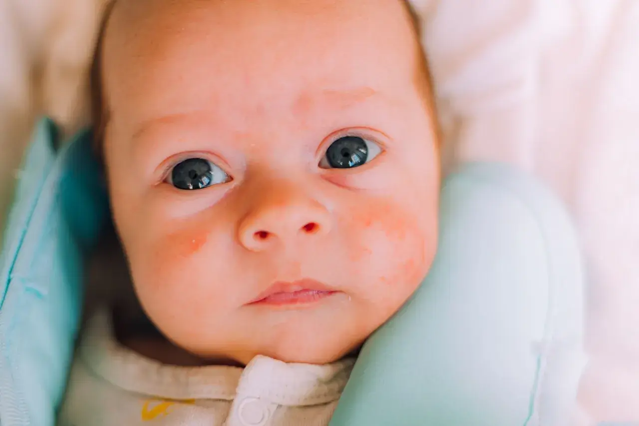 Nahaufnahme eines Babys mit roten Flecken im Gesicht, die auf Hitzepickel hindeuten.