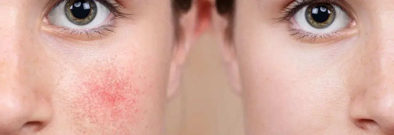 Vorher-Nachher-Vergleich: Rötungen bei Rosacea werden durch Hyaluron deutlich gemildert.
