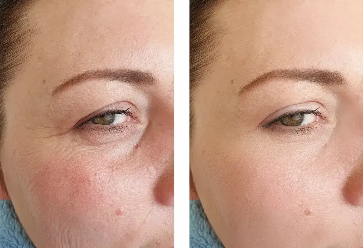 Vorher-Nachher-Vergleich: Faltenreduktion durch Vitamin C oder Retinol. Die Haut wirkt glatter und jugendlicher.