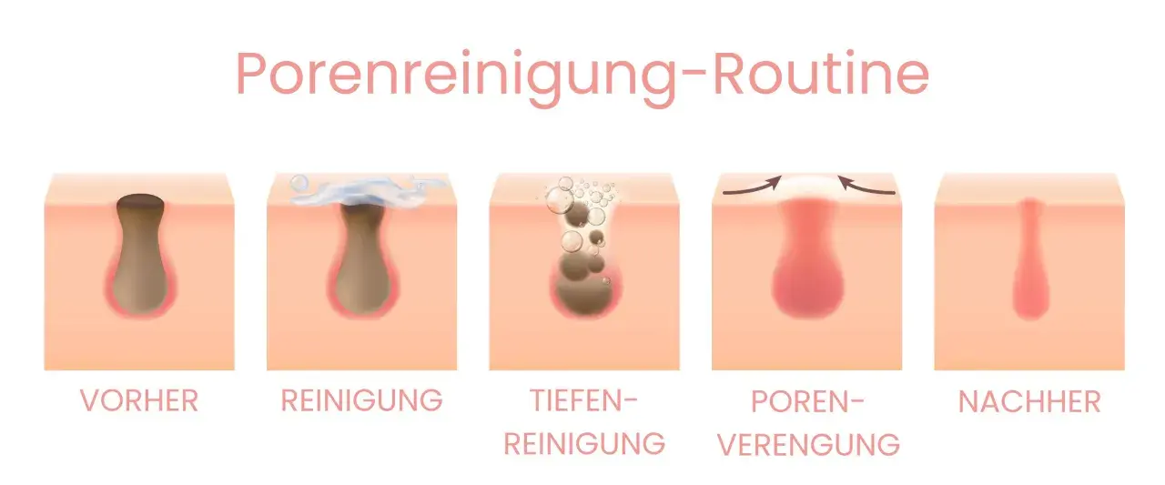 Schritt-für-Schritt-Anleitung zur Porenreinigung: Vorher sind geschlossene Mitesser sichtbar, dann Reinigung, Tiefenreinigung, Porenverengung und schließlich das Ergebnis.