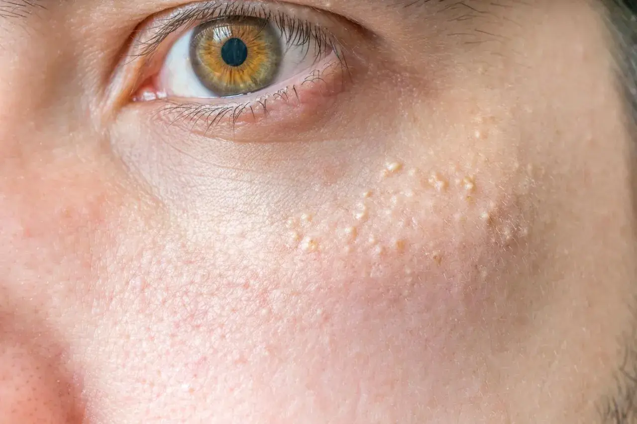 Nahaufnahme des Gesichts mit kleinen weißen Pickelchen, die sich auf der Haut am Kinn und unter dem Auge befinden.