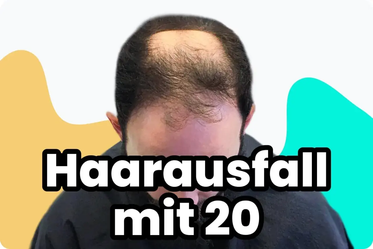 Mann mit Haarausfall mit 20 Jahren, der sich Sorgen macht.