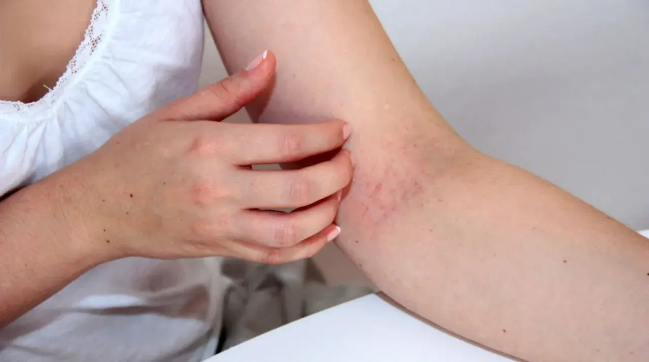 Juckende Haut am Arm, Anzeichen von Neurodermitis. Vielleicht hilft ein Cleopatra-Bad?