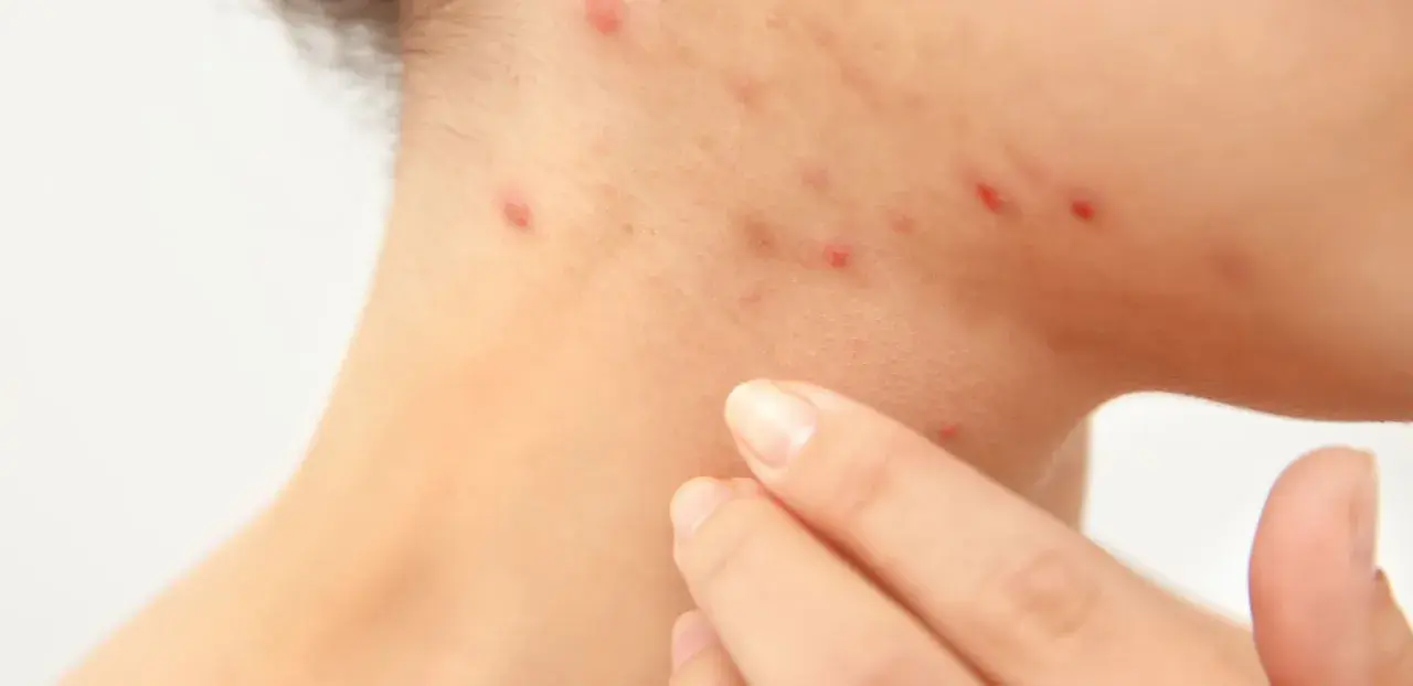 Haut mit Rötungen und Pickelchen, die auf Stress und damit verbundene Cortisol-Akne hindeuten. Eine Hand berührt sanft die betroffene Stelle.