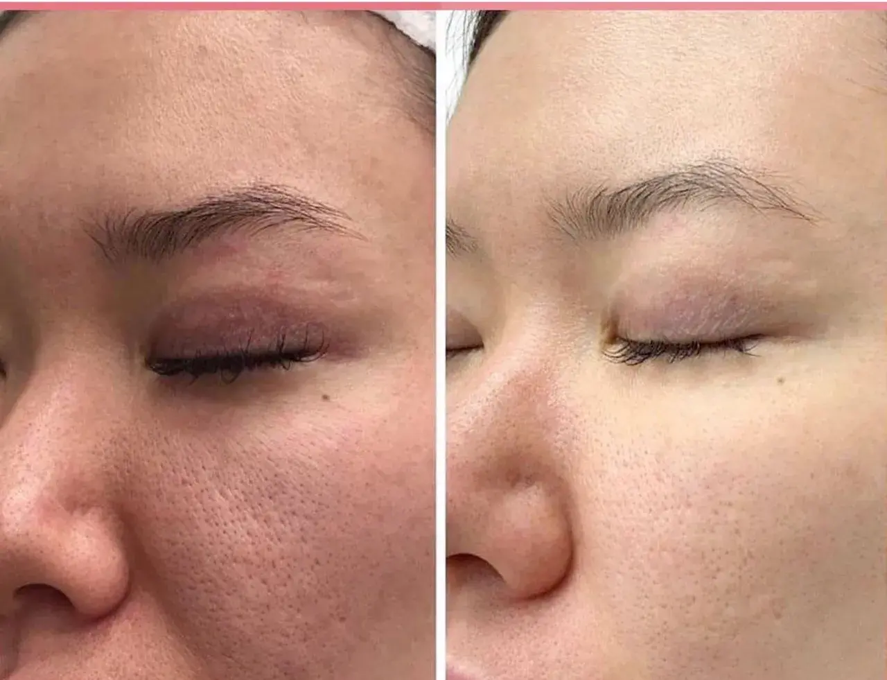 Vergleich: Hautbild vor und nach der Anwendung von Retinol. Deutlich sichtbare Poren werden feiner und die Haut wirkt glatter.
