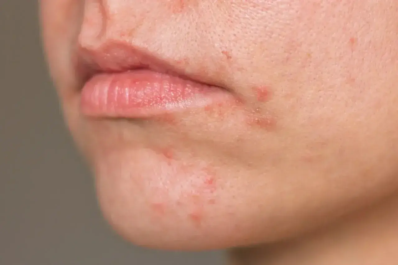 Nahaufnahme von geröteter Haut um den Mund, die auf periorale Dermatitis hinweist. Sanfte Hautpflege ist hier wichtig.