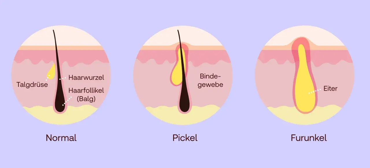 Illustration zeigt, was tun bei Furunkel: Normal, Pickel und Furunkel mit Eiterbildung im Haarfollikel.