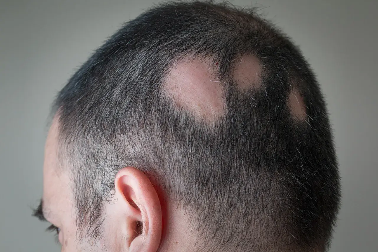 Mann mit kreisrundem Haarausfall am Hinterkopf. Vielleicht helfen Hausmittel gegen Kopfhautjucken.