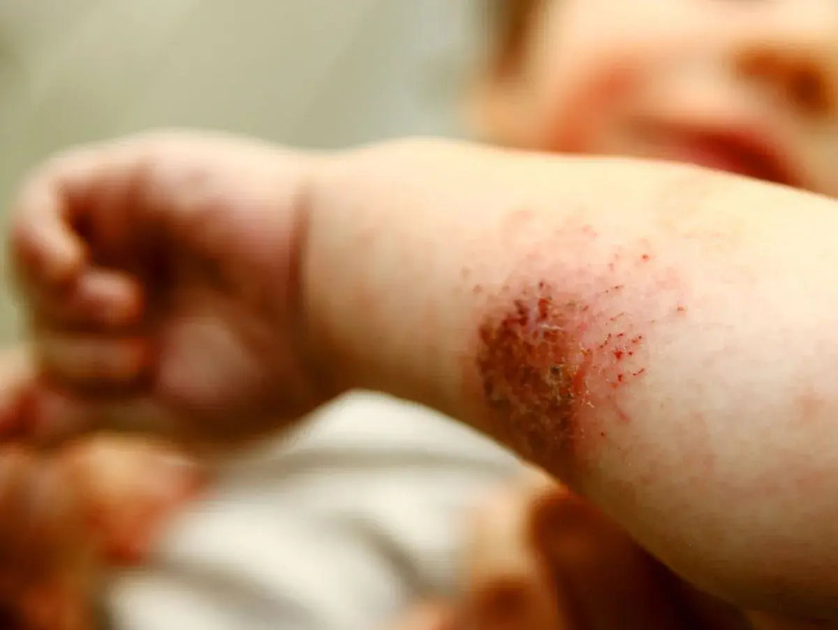 Babyarm mit geröteter, wund gekratzter Stelle, die stark juckt. Neurodermitis-Schub.
