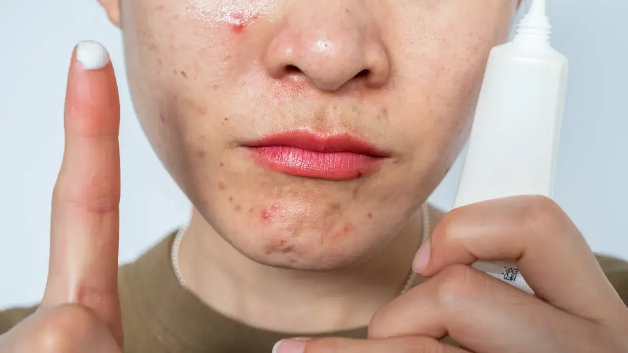 Ein Finger mit Creme zeigt auf unreine Haut. Ein Kampf gegen Akne mit Retinol beginnt.
