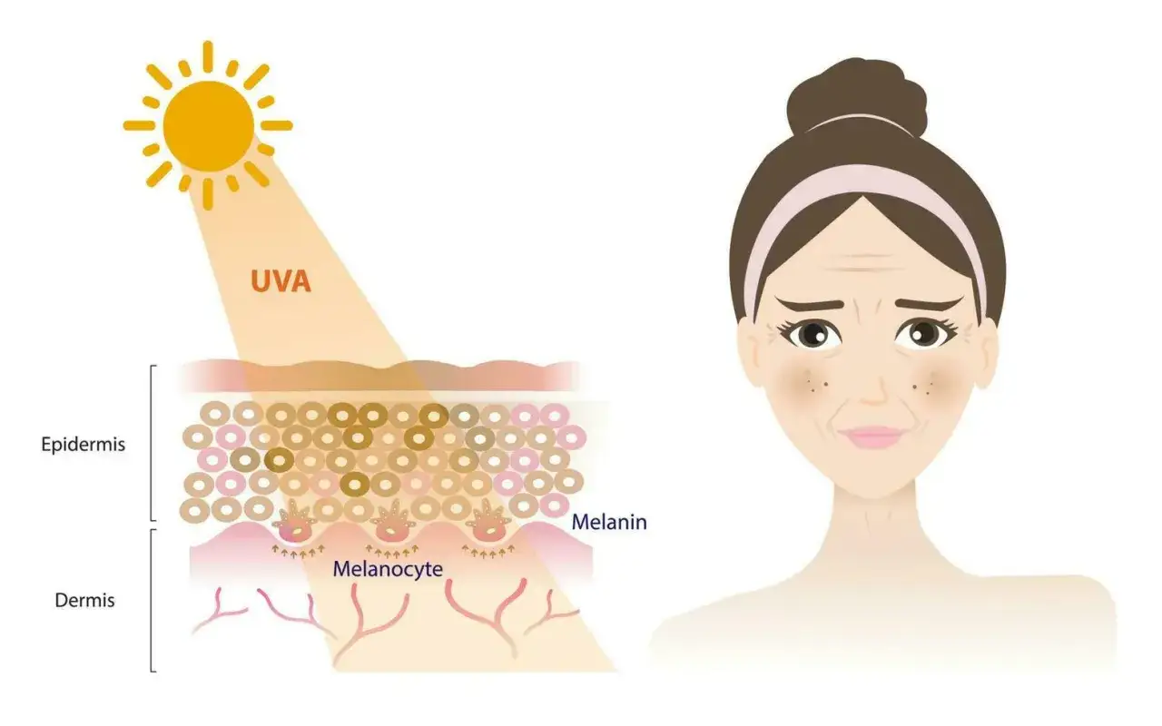 UVA-Strahlung beeinflusst Melanozyten in der Haut. Die Frage, wie lange bleibt man braun, h&auml;ngt von der Melaninproduktion ab.