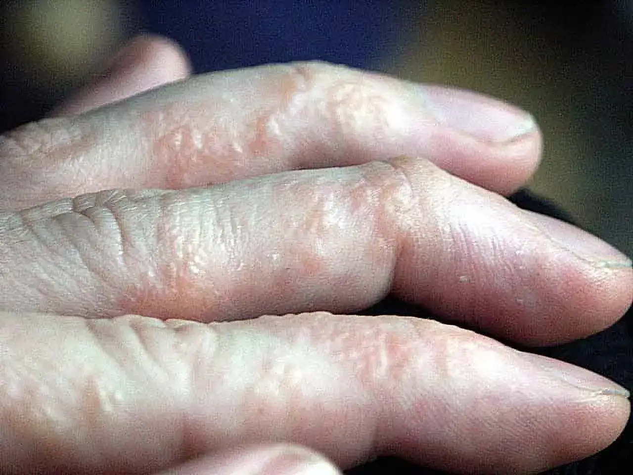 Hände mit roten, schuppigen Stellen und kleinen Bläschen, typisch für dyshidrotisches Ekzem.