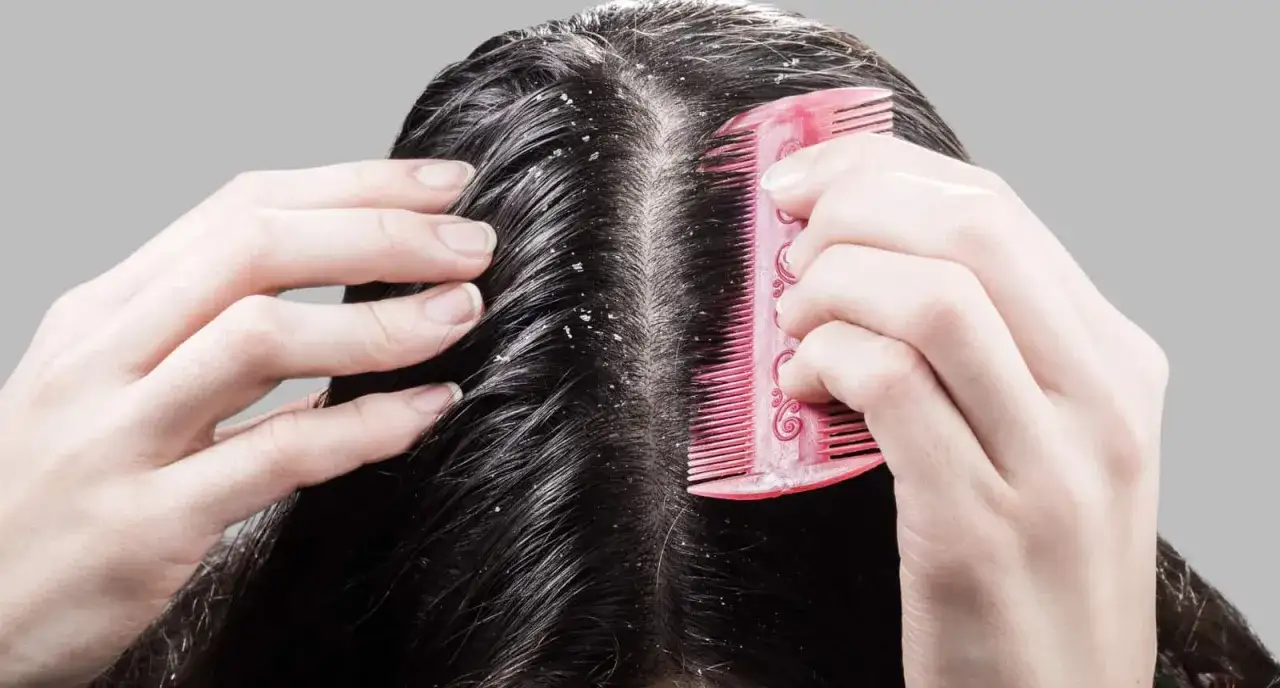Hände kämmen eine trockene Kopfhaut mit sichtbaren Schuppen. Dies kann ein Zeichen für Haarausfall sein.