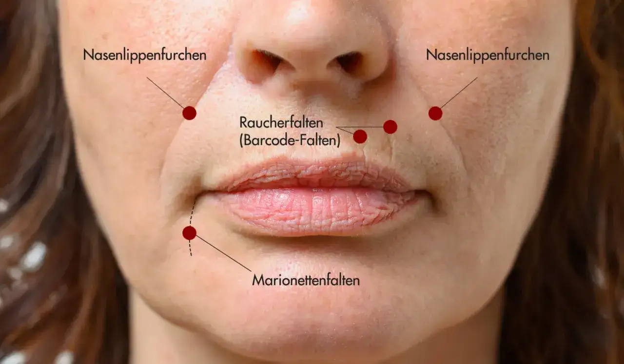 Nahaufnahme eines Mundes mit sichtbaren Nasolabialfalten, Raucherfalten und Marionettenfalten, die auf natürliche Weise durch das Leben und Lachen entstanden sind.