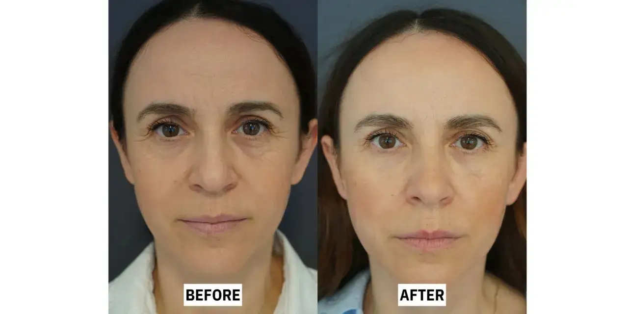 Vorher-Nachher-Vergleich: Die Haut der Frau wirkt nach der Anwendung von Retinol glatter und jugendlicher.