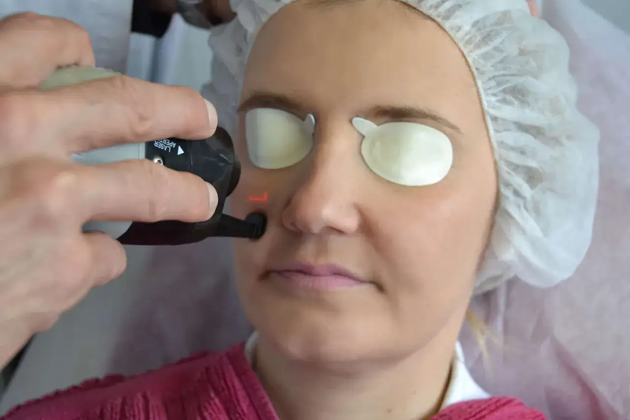 Behandlung von Lachfalten im Mundbereich mit einem Laser. Die Augen sind geschützt.
