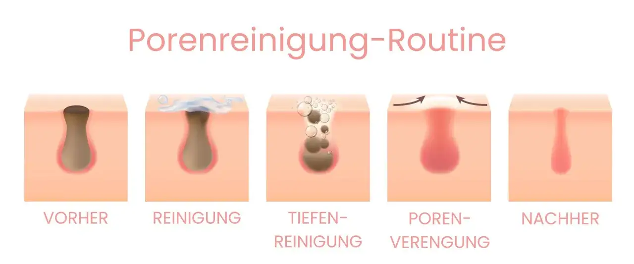 Schritt-für-Schritt-Anleitung zur Porenreinigung: Vorher sind geschlossene Mitesser sichtbar, dann Reinigung, Tiefenreinigung, Porenverengung und schließlich das Ergebnis.