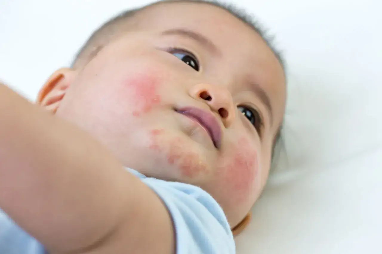 Babygesicht mit geröteten Wangen und Ausschlag, möglicherweise durch Pollenallergie verursacht.