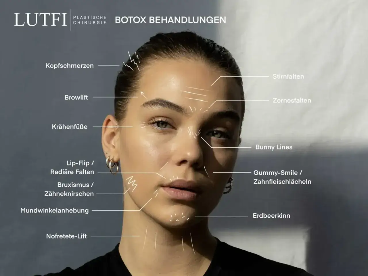 Botox-Behandlungen gegen Zornesfalten, Stirnfalten und Krähenfüße. Infos zu weiteren Anwendungen wie Browlift, Bunny Lines und mehr.