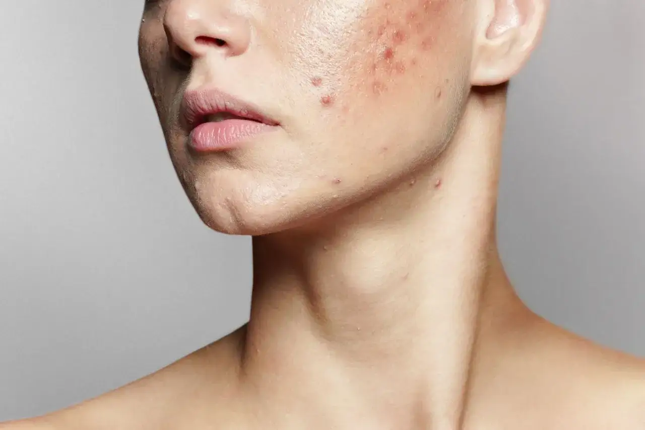 Nahaufnahme eines Gesichts mit Pickeln und Unreinheiten. Vitamin C gegen Pickel kann helfen, die Haut zu klären und Entzündungen zu reduzieren.