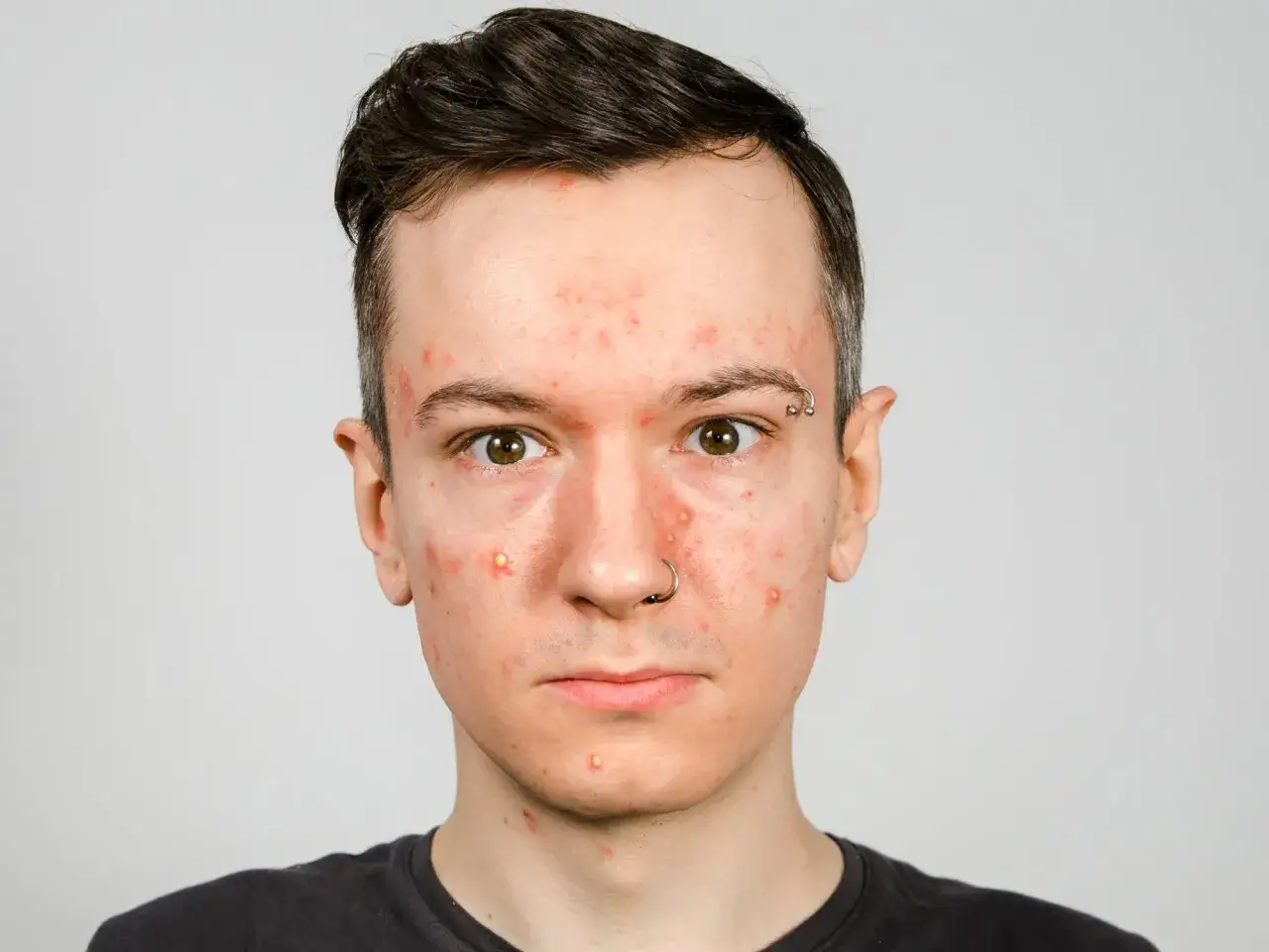 Junger Mann mit Akne und einigen gelben Pickeln im Gesicht. Er hat einen Nasenring und einen Augenbrauenpiercing.