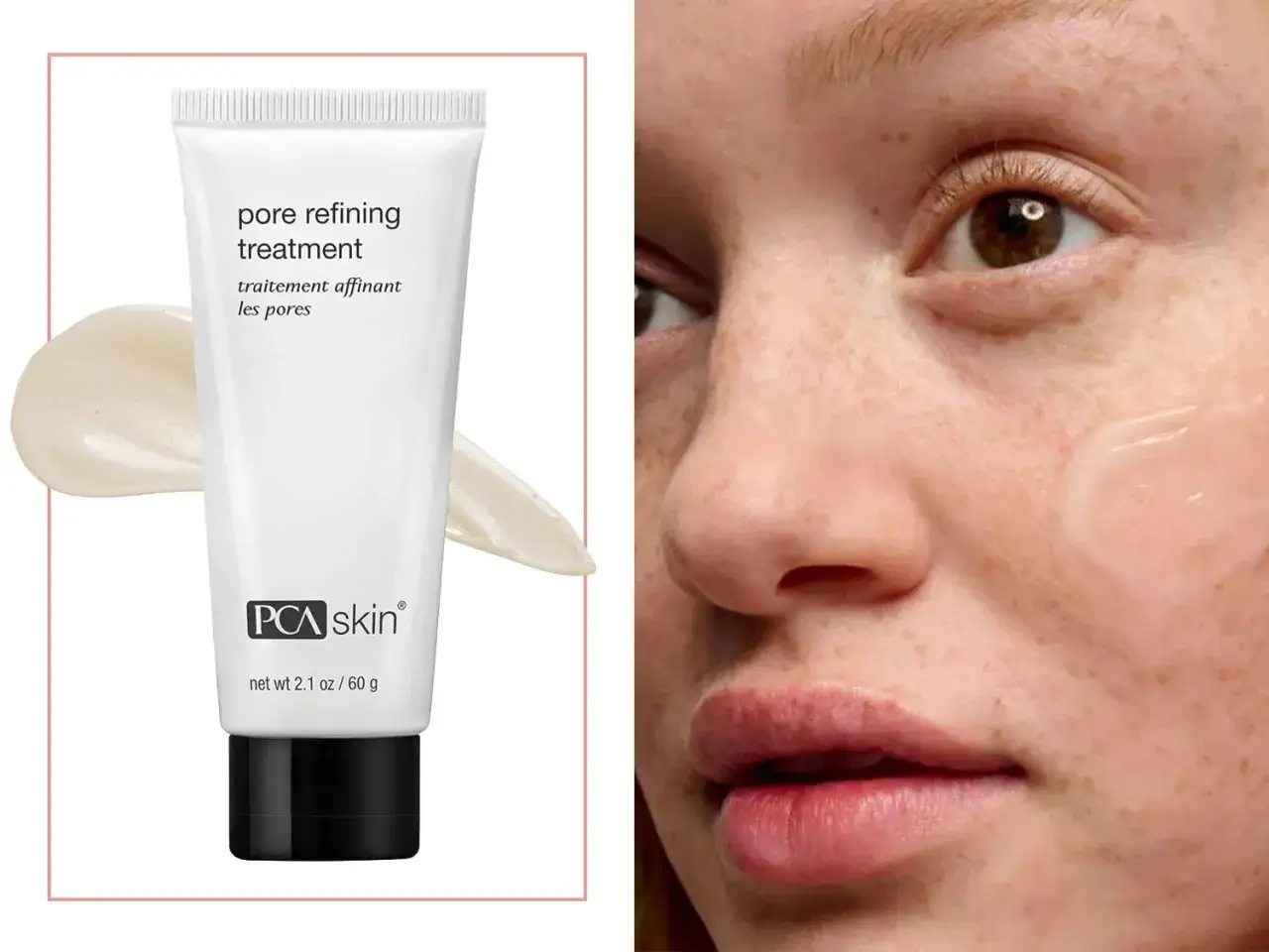 PCA Skin Pore Refining Treatment, eine nicht komedogene Formel, wird auf die Haut aufgetragen, um das Erscheinungsbild von Poren zu verfeinern.